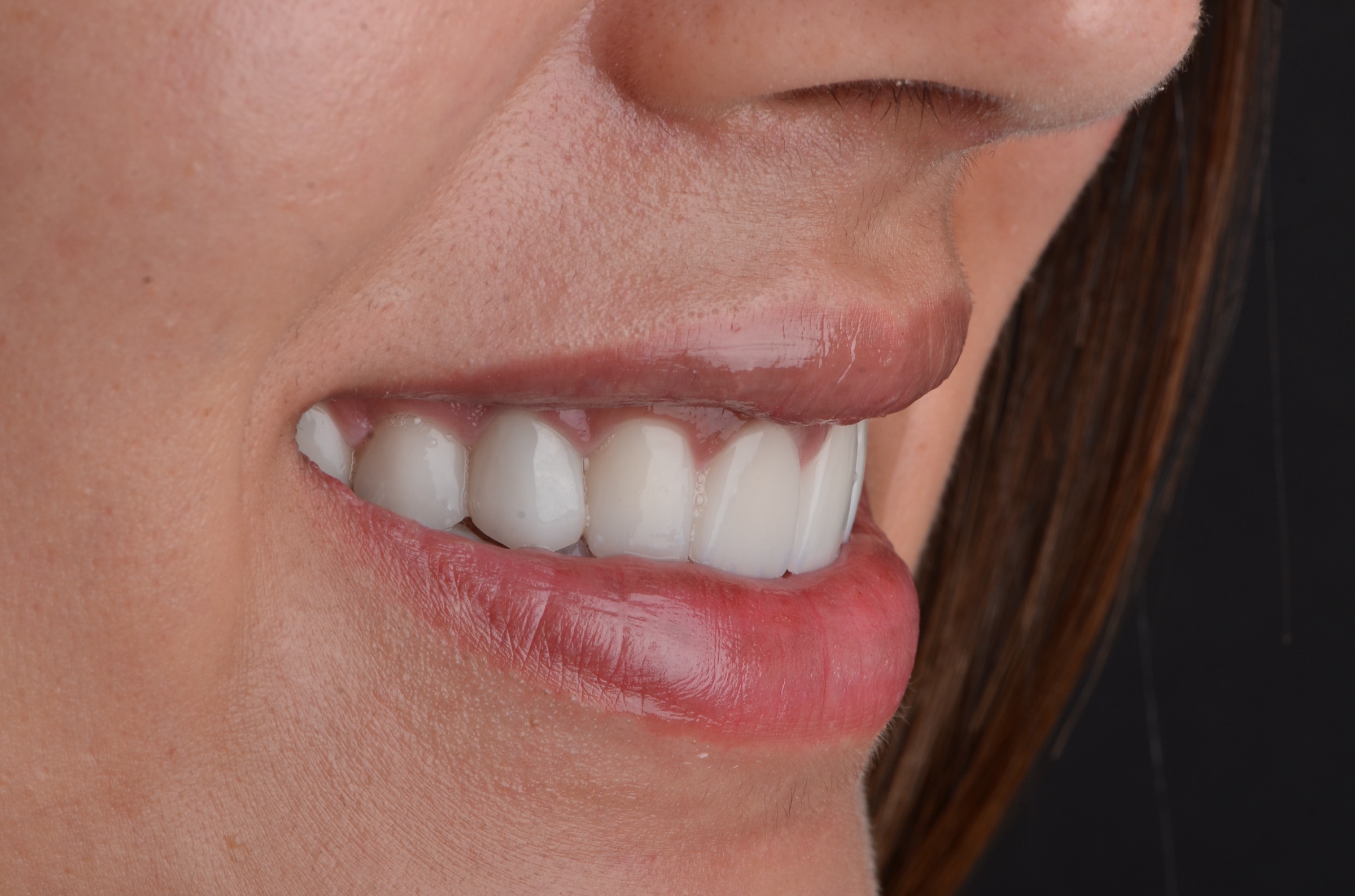 Sonrisa tratada en Dentz, de tres cuartos
