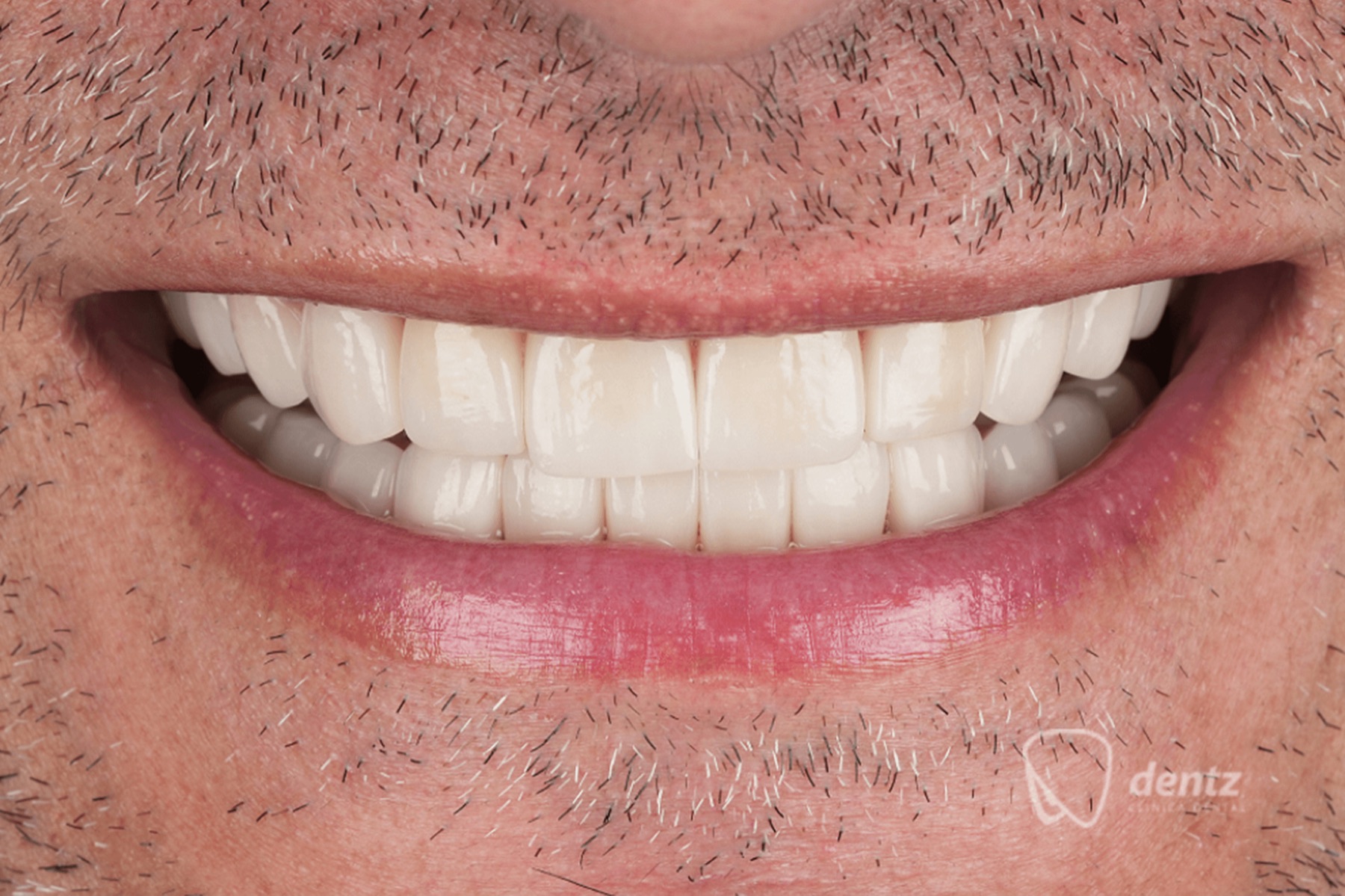 Resultado de diseño de sonrisa